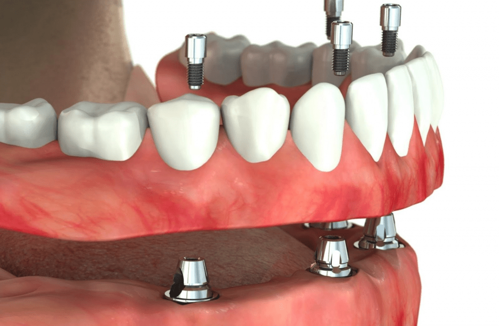 Зубные имплантаты - какие работы проводятся?