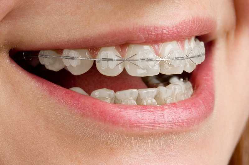Лингвальные брекеты помогут решить детские зубные проблемы